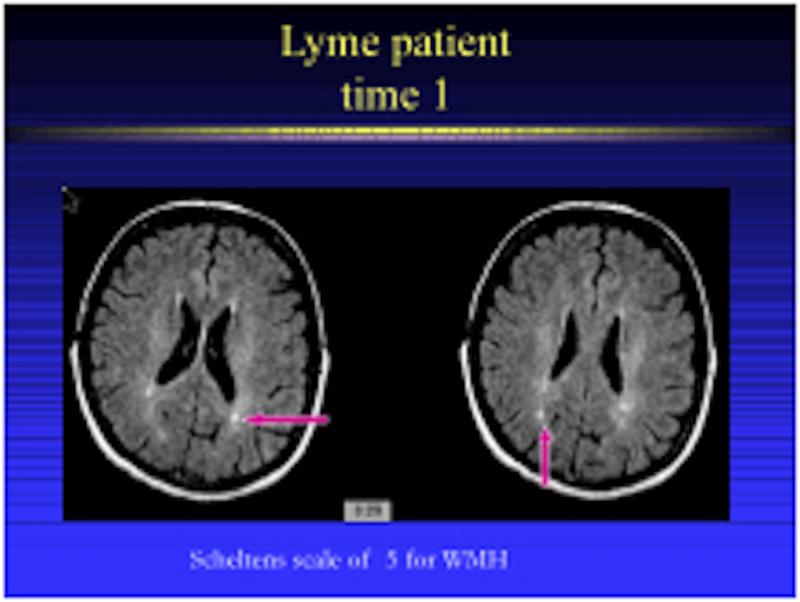 lyme brain fog treatment burbur